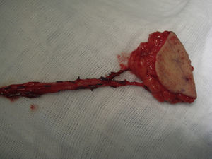 Detalle de hemoclips tras disección intramuscular del pedículo del colgajo.