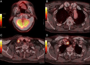 PET-CT 14 meses posquirúrgico SH. A) Cavidad oral. B) Nódulo pulmonar. C) Ganglio supraclavicular derecho. D) Ganglio paratraqueal derecho.