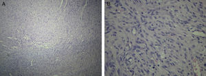 Aspecto histológico con hematoxilina-eosina. Se observa disposición de células fusiformes: A) 10x de magnificación. B) 40x de magnificación.