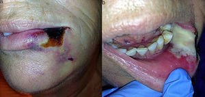 a) Zona de necrosis delimitada que afecta a piel, bermellón y comisura del labio inferior, rodeada de un halo blanco y otro violáceo externo; b) Visión intraoral, donde se observa necrosis en la mucosa.