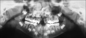 Paciente varón, 7/2 años de edad, con el diagnóstico de hendidura labial, alveolar y palatina izquierda. En la ortopantomografía se observa un diente supernumerario a nivel maxilar izquierdo, dentro de la hendidura alveolar.