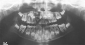Paciente mujer, 6/9 años de edad, con el diagnóstico de hendidura labial, alveolar y palatina derecha. En la ortopantomografía se observa diente supernumerario a nivel maxilar derecho, específicamente, dentro de la zona de la hendidura alveolar.