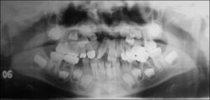 Paciente varón 7/5 años de edad, con el diagnóstico de hendidura labial, alveolar y palatina derecha. En la ortopantomografía se observa un diente supernumerario a nivel maxilar derecho, específicamente en la hendidura alveolar.