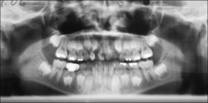 Paciente mujer 7/9 años de edad, con el diagnóstico de hendidura labial y alveolar bilateral. En la ortopantomografía se observa diente supernumerario a nivel maxilar derecho, dentro de la zona de la hendidura alveolar.