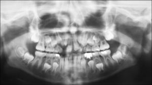 Pacientes según prevalencia y posición de dientes supernumerarios. Hospital Nacional de Niños (2012).