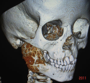 Aspecto tomográfico de osteoblastoma mandibular en niña de 6 años de edad.