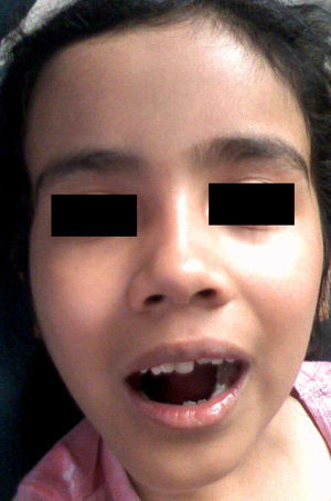 Aspecto quirúrgico de resección de osteoblastoma mandibular derecho en niña de 6 años de edad.