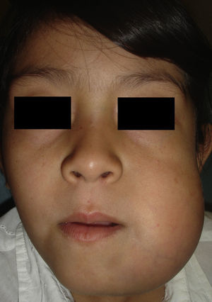 Ameloblastoma mandibular izquierdo en niña de 8 años de edad.