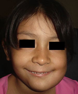 Aspecto facial posterior a resección de ameloblastoma mandibular izquierdo con colocación de prótesis de reconstrucción mandibular.