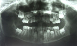 Área radiolúcida extensa en mandíbula del lado derecho, diagnosticada como ameloblastoma en varón de 9 años de edad.