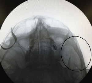 Reducción exitosa de la FAAC izquierda del paciente de la figura 3, evaluada de forma objetiva con una imagen intraoperatoria obtenida con arco en C.