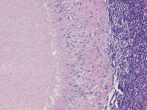 Linfadenitis granulomatosa necrosante: centro necrótico, corona de células epitelioides y reacción linfocitaria (hematoxilina & eosina ×20).