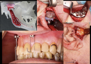 (a) Custom made TMJ prosthesis with 3-D stereolithographic model, (b) and (c) fossa and mandibular component of the prosthesis, (d) final occlusion, and (e) fat graft to fill death space.