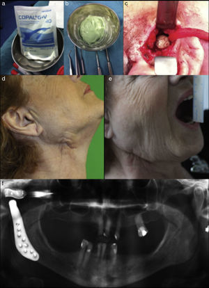 (a) and (b) Polymethyl methacrylate orthopedic cement impregnated with antibiotic, (c) bone cement placed to maintain fossa space, (d and e) eleven months after new TMJ replacement free of symptoms with good mouth opening, and (f) radiographic control after replace a new custom made fossa and reimplant the condylar component.