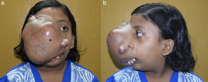 a, b) Front and side profile of the patient showing swelling over the right side of the face, causing distortion and displacement of right eye outwards and laterally.
