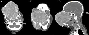 (A) (Axial), (B) (Coronal) and (C) (Sagittal) sections of contrast enhanced CT scan of the nose and paranasal sinuses showing a 17cm×12cm×11cm expansile, heterogeneously enhancing soft tissue attenuating mass lesion, causing gross deformity of the face.