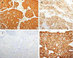 A) Mamoglobina (IHQ mamoglobina, ×100). B) Tinción del tumor con GCDFP-15 (IHQ BRST-2, ×100). C) Negatividad del MASC para receptores estrogénicos. D) MASC fuertemente positivo para proteína S-100 (IHQ S-200, ×100).