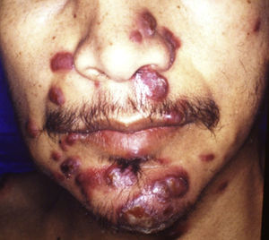 Sarcoma de Kaposi en tegumentos faciales; nódulos cutáneos coalescentes de color marrón en un paciente masculino en la 3.ª década de la vida.