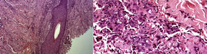 A la derecha se observa una proliferación vascular localizada entre folículo piloso y su músculo erector, se observa hemorragia importante en la dermis reticular (HyE 10x). A la izquierda en la dermis reticular se observan canales vasculares estrechos, formados por células alargadas, fusiformes asociadas a extravasación eritrocitaria (HyE 40x).