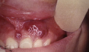 Sarcoma de Kaposi nodular en encía insertada que puede confundirse con un hemangioma o granuloma piógeno.