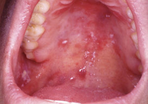 Sarcoma de Kaposi en paladar y candidiasis oral pseudomembranosa.