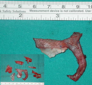 Fragmentos de hueso y cartílago septal obtenidos en la paciente de las figuras 3, 4, 7 y 8, así como la remodelación y fijación de los fragmentos en forma de «L» con suturas de nailon.