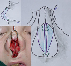 Esquema de la fijación del injerto en L a la zona K y a la espina nasal anterior, e imagen intraoperatoria de la paciente de las figuras 5, 6, 9 y 10.