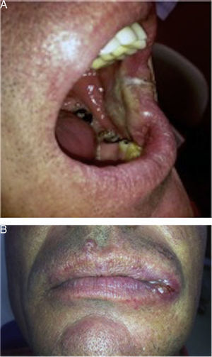 Lesión clínica en mucosa yugal (A) y Comisura izquierda (B).
