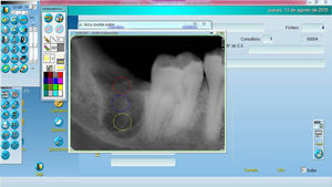 Evaluación radiográfica software Owandy quick vision del equipo radiográfico. En Círculo superior: zona cervical; círculo intermedio: zona media; círculo inferior: zona apical.
