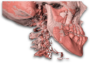Imagen 3D al final del procedimiento BIRD. Superposición del movimiento del hueso hioides con respecto a la posición inicial (avance del hioides de 11mm).