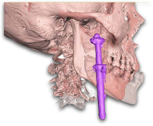 Imagen 3D al final del procedimiento BIRD. Superposición del movimiento mandibular con respecto a la posición inicial (avance de pogonion de 15,6mm).