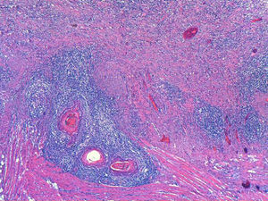 Carcinoma escamoso queratinizante bien diferenciado, infiltrando capas musculares. Se observa inflamación aguda y crónica, y reacción gigantocelular acompañante (hematoxilina-eosina ×4).