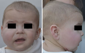 Fotografías frontal y lateral a los 8 meses de edad.