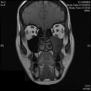 TC que muestra la lesión de FM en maxilar superior izquierdo.