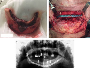 a) Pieza de mandibulectomía en paciente de grado 3. 4 b) Reconstrucción mandibular en paciente de grado 3. c) OPG luego de la reconstrucción.