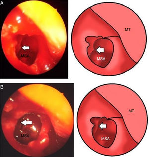 (A) Operative endoscopic view show maxillary sinus antrostomy (MSA) explored the floor of orbit and the fracture of the floor is noted (arrow), and middle turbinate (MT). (B) Operative endoscopic view show maxillary sinus antrostomy (MSA), the reduction of fracture was done (arrow), and middle turbinate (MT).