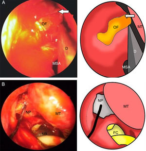 (A) Operative endoscopic view show the bone fragments entered medially and removed to expose the lamina papyracea defect (arrow), MSA=maxillary sinus antrostomy, D=dissector. (B) Operative endoscopic view show following to the Medpore® implantation and nasal pack (NP) inserted and a Foley's catheter (FC/NB) size 12 was inserted in the maxillary sinus to support the floor, maxillary sinus ostium (MSO), middle turbinate (MT).
