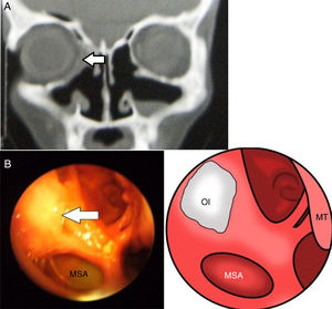 (A) Postoperative CT scan show the reconstruction of both medial and inferior wall of orbit (Medpore®) implantation is not radiopaque (the arrow). (B) Postoperative endoscopic view show maxillary sinus antrostomy (MSA) and the reconstruction of both medial and inferior wall of orbit with (Medpore®) implantation (the arrow).