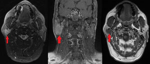 Imágenes de resonancia magnética nuclear. Se muestra en detalle la lesión parotídea de bordes bien definidos con naturaleza hipercaptante en T1 en corte axial y coronal en las imágenes de la izquierda e hipocaptante en T2 en la imagen a la derecha.