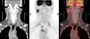 Imagen coronal de PET-TAC. Se observa la hipercaptación en parótida y en múltiples áreas de mediastino.