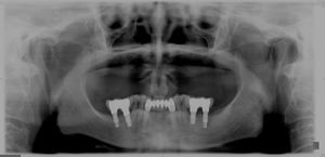 Panoramic X-ray of case 1 showing bone loss surrounding implant on the left side.