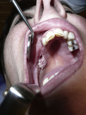 Verrucous lesion in upper maxilla of case 3.