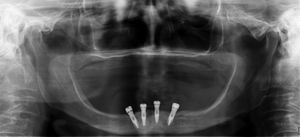 Panoramic X-ray of case 4 previous to tumoral resection of the third quadrant.