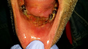 Lesion surrounding dental implants of the anterior sector of the jaw of case 6.