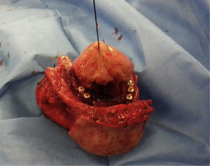 Sample of the resection of case 6, which included the jaw (from angle to angle), the ventral face of the tongue and the skin of the chin.