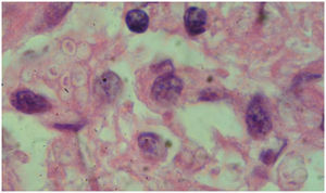 Tinción con hematoxilina y eosina (100X) correspondiente a la punción biópsica pulmonar. Pueden apreciarse varias levaduras intracelulares de pequeño diámetro (3–4μm).