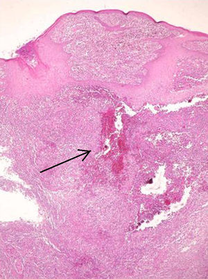 Histopatología: presencia de cuerpo extraño vegetal (tinción de hematoxilina-eosina, 200×).