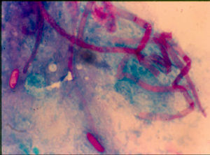 Tinción con ácido periódico de Schiff de una muestra de lesión corneal. Se observan hifas teñidas rodeadas de exudado inflamatorio (40×).