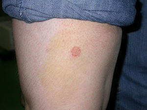 Annular lesion on human leg. Flat B-girl.