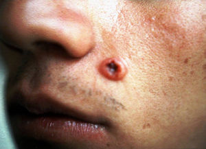 Lesión cutánea del labio superior en forma de tubérculo ulcerado cubierto por una costra.